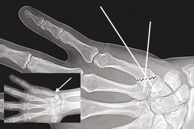 LITTLE METACARPAL FRACTURES | Hand Surgery Resource